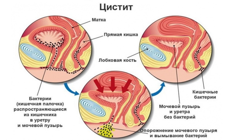 Воспаление После Секса