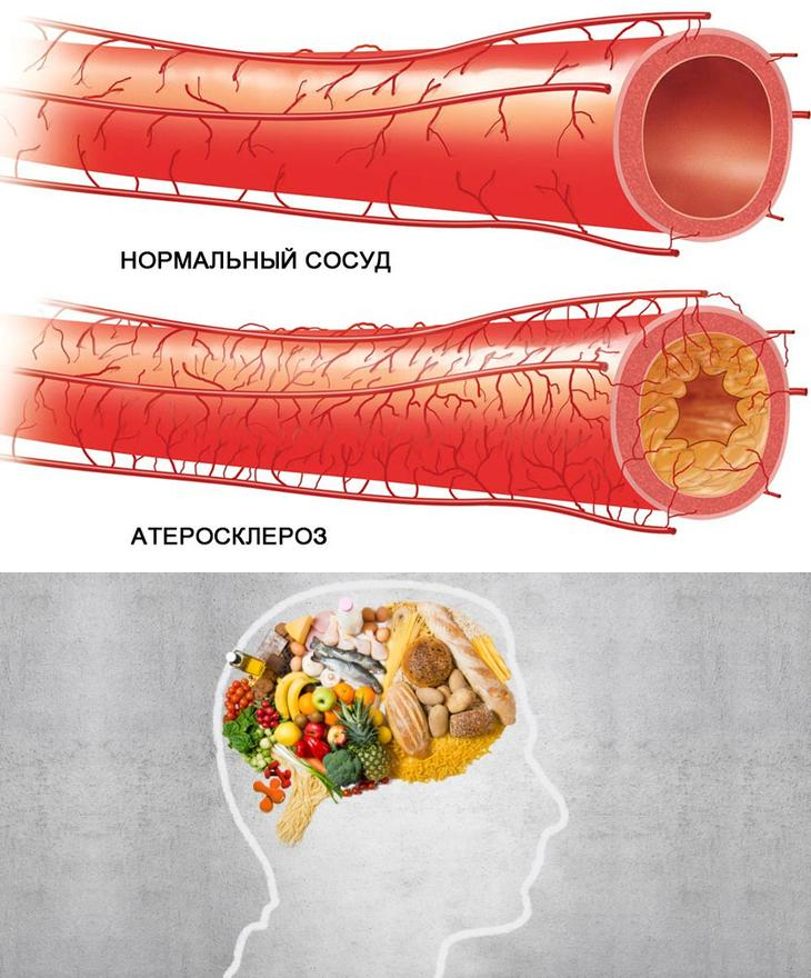 Как проверить сосуды на тромбы и холестериновые. Кровеносные сосуды с бляшками. Атеросклеротические бляшки в сосудах.