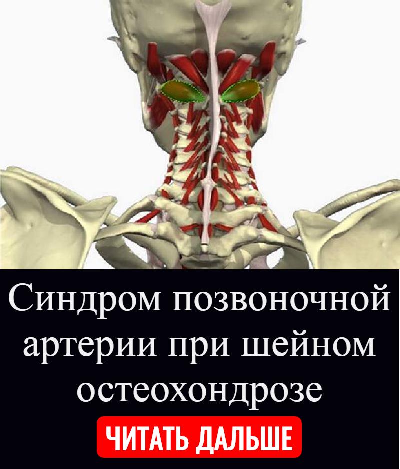 Синдром позвоночной артерии что это такое. Синдром позвоночной артерии (синдром Унтерхарншейдта). Синдром позвоночной артерии при шейном. Синдром позвоночной артерии при шейном остеохондрозе. Позвоночная артерия шейного отдела.