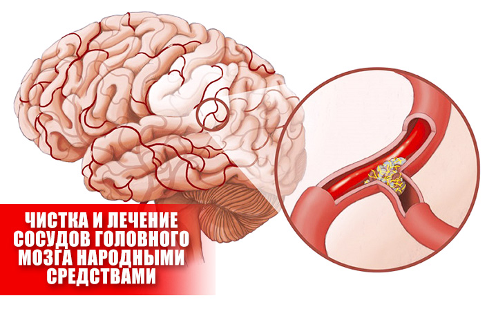Сосуды головного мозга лечение народными средствами
