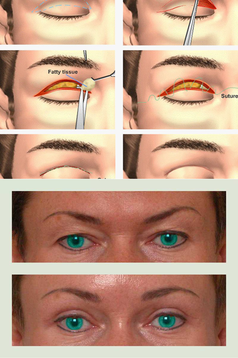 Блефаропластика верхних век заживление. Блефаропластика верзн их век. Блефаропластика верхних век. Блефаропластика верхних век реабилитация. Блефаропластика верхних век реабилитация по дням.