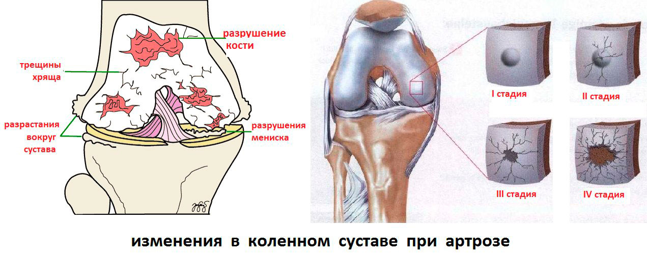 Изменения в суставах. Хрящ коленного сустава артроз. Разрушение хряща коленного сустава. Стадии разрушения суставов. Артроз коленного сустава стадии.