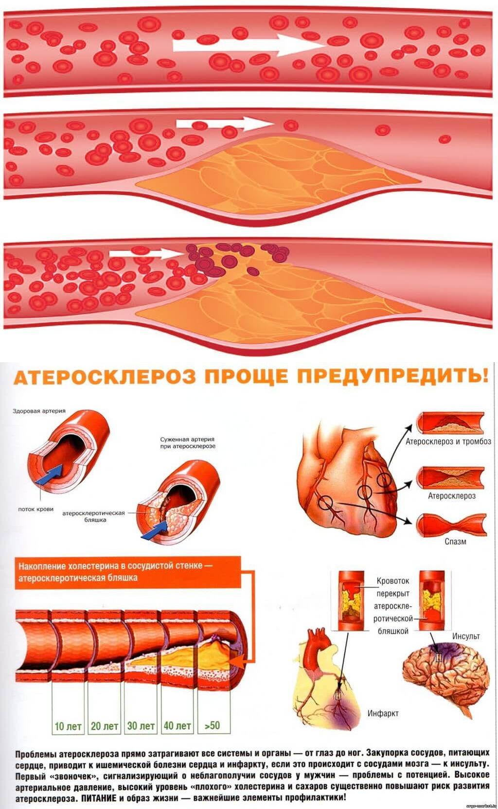 Как можно проверить сосуды. Атеросклероз и образование атеросклеротических бляшек. Атеросклероз сосудов сердца симптомы. Атеросклеротическое поражение кровеносных сосудов. Атеросклероз бляшки сосудов.