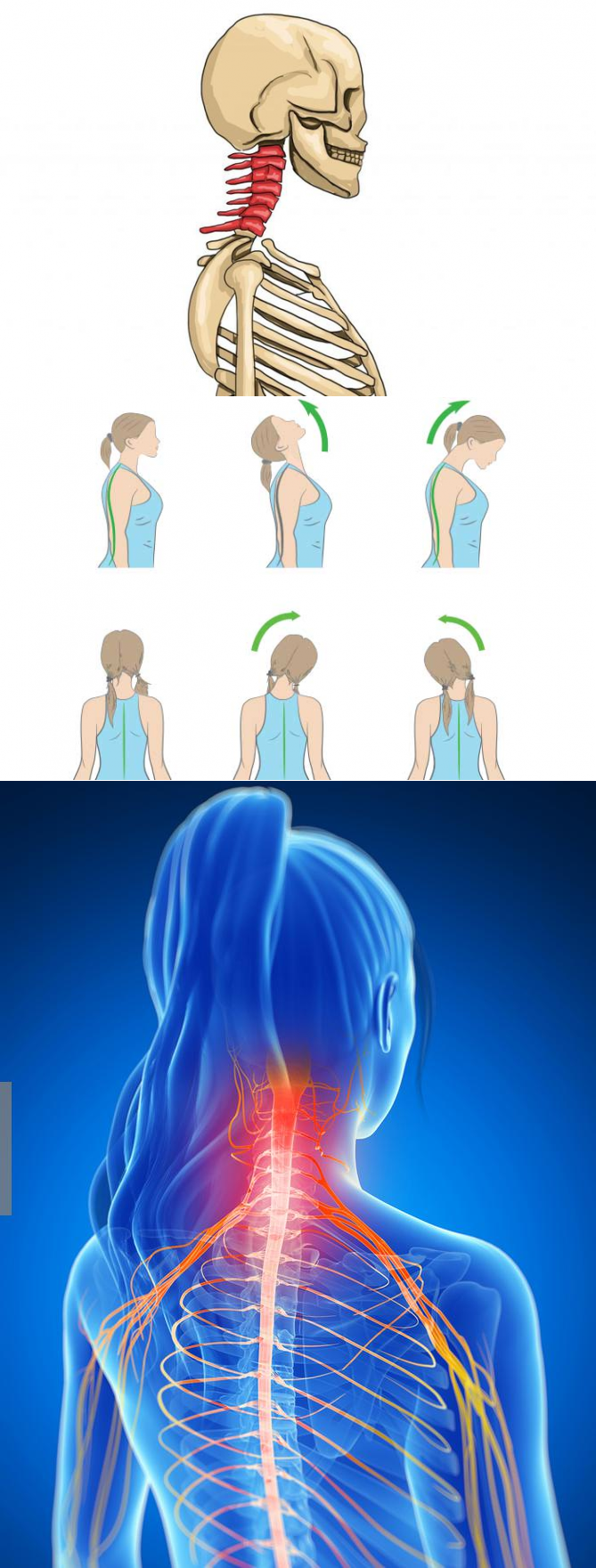 Шейный остеохондроз защемление нерва. Симптомы защемления шейного отдела. Защемление нерва в шее симптомы. Радикулопатия грудного отдела позвоночника. Болит шея защемление нерва.