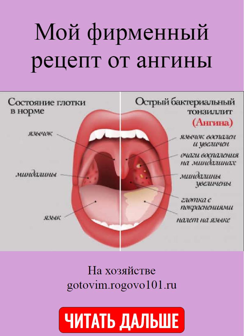 Во рту температура без. Острый тонзиллит катаральная форма.