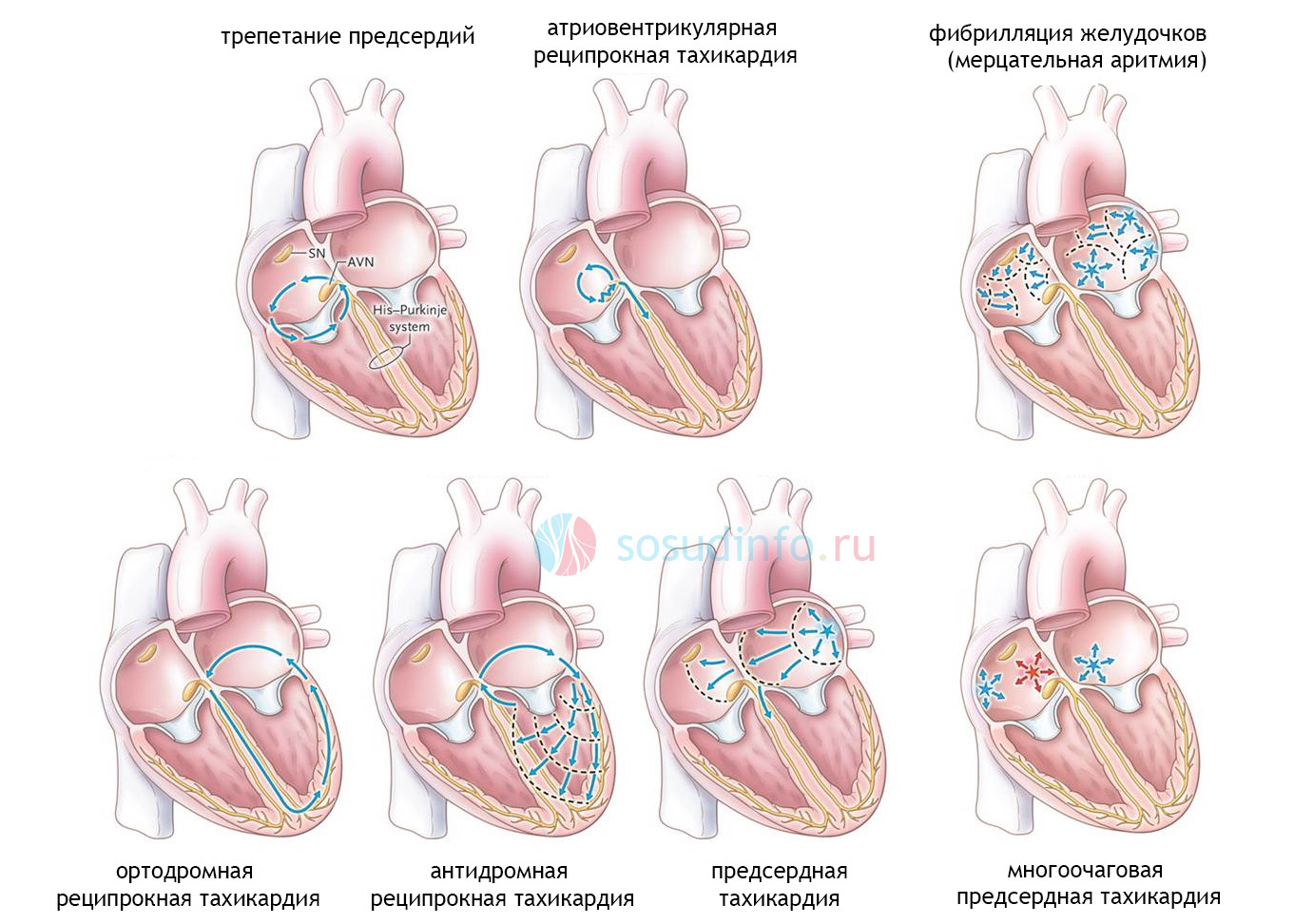 Тахикардия что. Тахикардия. Тахикардия сердца. Физиологическая тахикардия. Виды тахикардии.