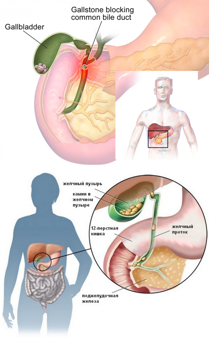 Как живут без желчного отзывы. Камни в жёлчном пузыре пузыре. Желчные камни в желчном пузыре.