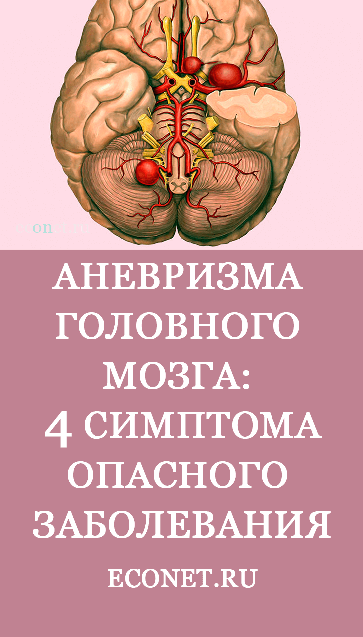 Аневризма головного мозга: 4 симптома смертельно опасного заболевани� |  Женские штучки | Постила