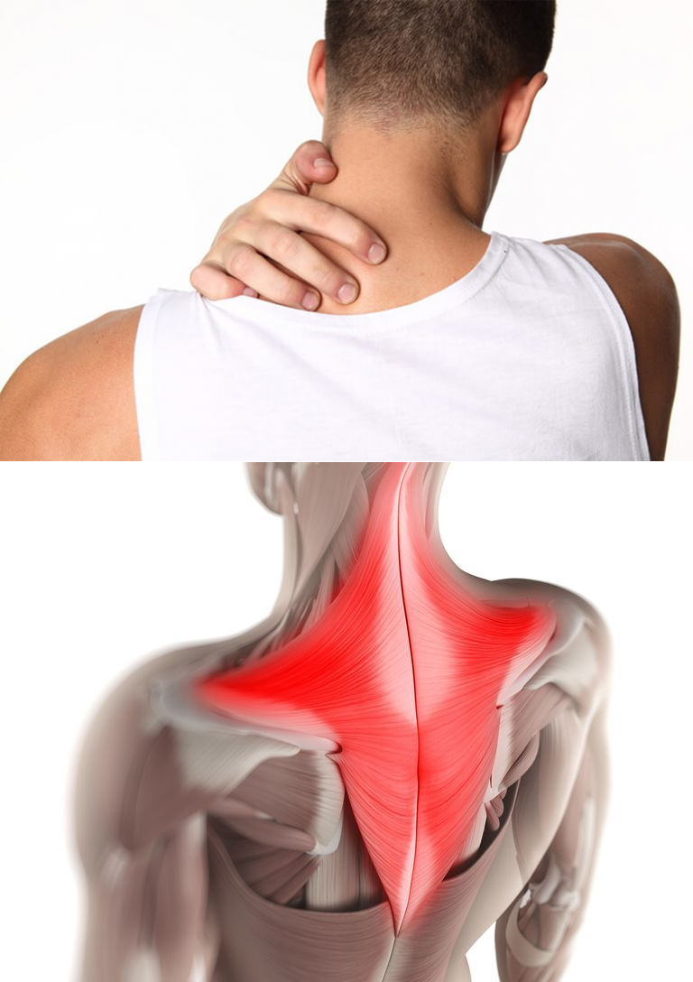 Сильные боли в области спины. Миозит трапециевидной мышцы. Спазмированная мышца. Перенапряжение мышц шеи.