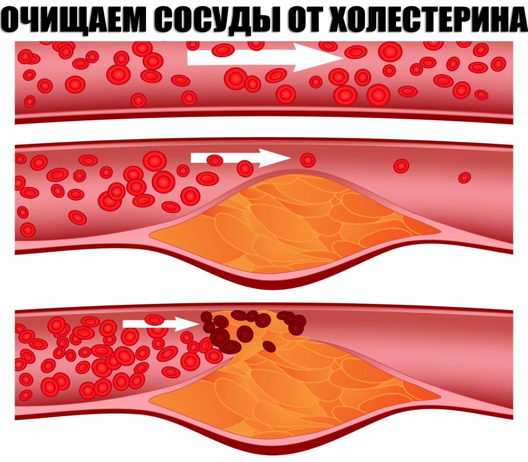 Кровь закупорка сосудов. Что такое атеросклероз, окклюзия. Холестериновые бляшки в сосудах. Атеросклеротическая окклюзия.