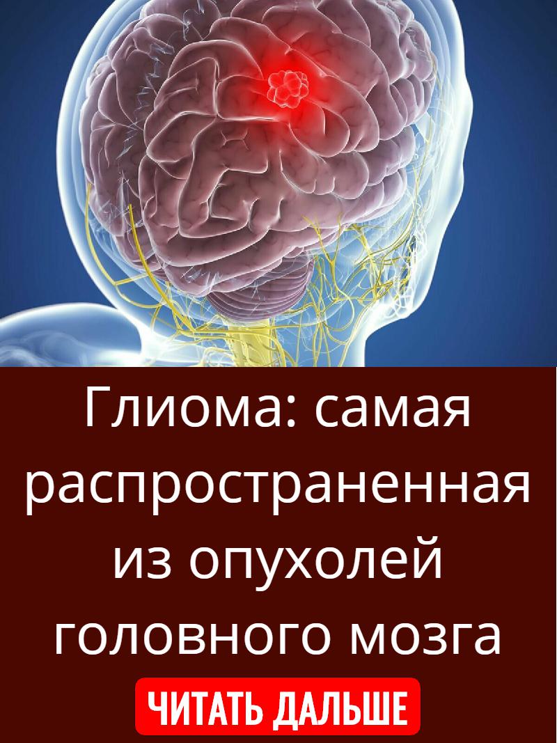 Глиома опухоль. Объемное образование головного мозга. Доброкачественная опухоль головного мозга.