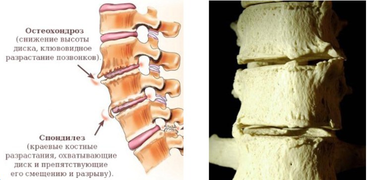 Изменение поясничного отдела позвоночника остеохондроз спондилоартроз