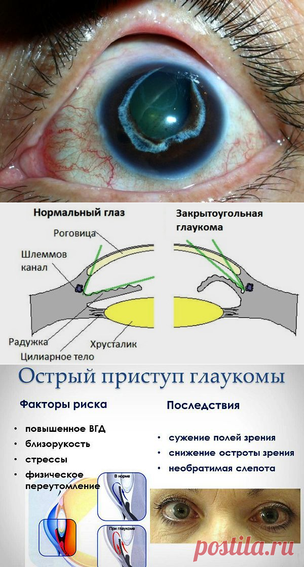 Можно вернуть зрение при глаукоме