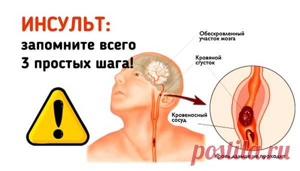 ИНСУЛЬТ: Запомните 3 простых шага, чтобы спасти жизнь себе или близким Инсульт прочно занимает первое место среди причин смертности. Взрослые, пожилые, и даже молодые, казалось бы, здоровые люди — инсульт может случиться с