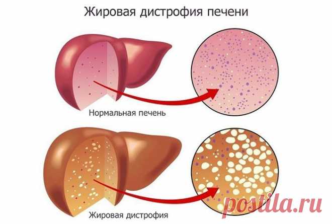 Натуральные настои при ожирении печени Ожирение печени легко поддается лечению — поможет правильное питание с низким содержанием жиров. Также вы можете готовить себе различные натуральные настои, которые помогут организму справится с болезнью.