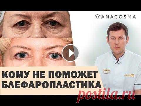 ❗️Блефаропластика: КОМУ НЕ ПОМОЖЕТ? ❗️❗️Нависшее веко как убрать ❗️БЕЗ ОПЕРАЦИИ❗️ Миронов Андрей Нужна блефаропластика или подтяжка век? Как выбрать процедуру, чтобы убрать нависшее веко? Операцию блефаропластика проводит пластический хирург Андре...