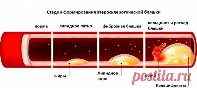 Чистка сосудов - убираем холестериновые бляшки. Возможно ли это? Ответ специалиста меня удивил | Дневник здоровья | Дзен