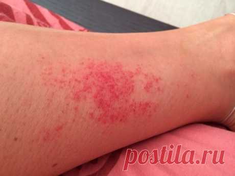 Красные пятна на ногах: причины, лечение и профилактика