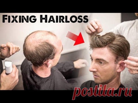 Mens Hairloss Treatment 2.0 | Amazing Hairstyle Transformation - Does it Work? | BluMaan 2018