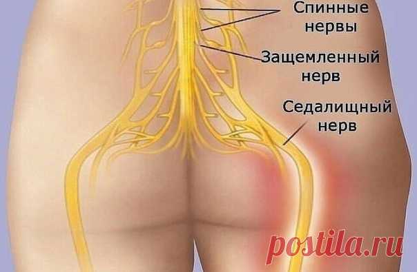 КАК РАЗБЛОКИРОВАТЬ СЕДАЛИЩНЫЙ НЕРВ  
Как разблокировать седалищный нерв: 2 простых способа снять боль
Седалищный нерв свое начало берет в поясничном отделе позвоночника и, проходя через ягодицы, тянется к ступне. Поэтому боль при его защемлении чувствуется особенно сильно.
Показать полностью...