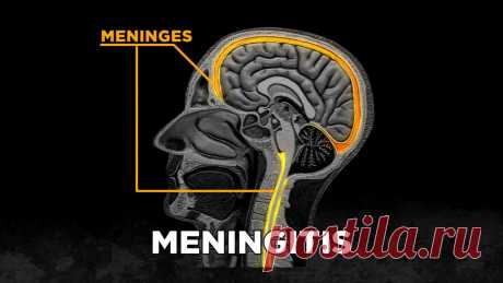 Особо опасен: признаки менингита у взрослых