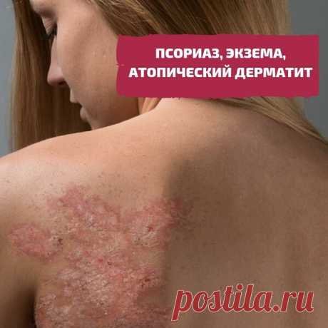 Псориаз, экзема, атопический дерматит. #1 | Гид по Телу 🌿 | Яндекс Дзен