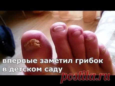 Грибок НЕ ВЕРНУЛСЯ спустя год Лечение грибка ногтей