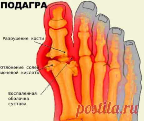 Лечение суставов народными средствами (артрит, подагра)