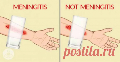 Распознайте признаки менингита: 8 симптомов, о которых вы должны знать!