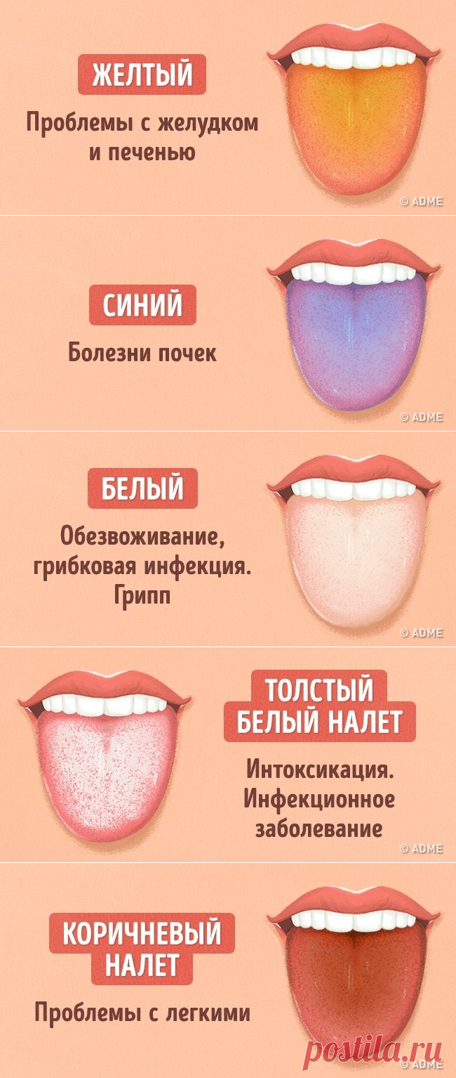 Язык при аппендиците. Заболевания по цвету языка. Заболевание по цвету языка у человека.