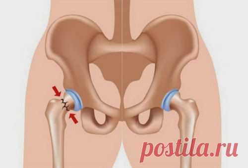 Перелом шейки бедра – не приговор | Друг пенсионера
