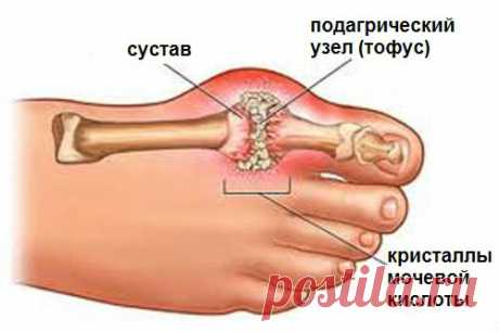 Как лечить отложение солей в суставах натуральными средствами — Здоровое Долголетие