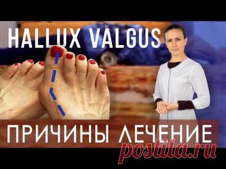 Косточка на ноге. Лечение Hallux valgus дома. Валик под спину | Как правильно лежать на валике