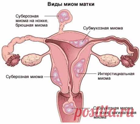 Миома матки | Симптомы, диагностика и лечение