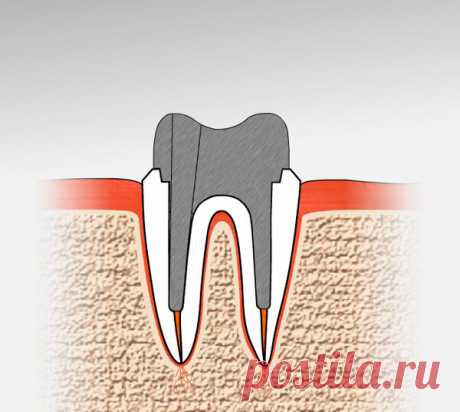 Не спешите удалять корни зубов, они могут очень пригодиться | записки зубного детектива | Яндекс Дзен