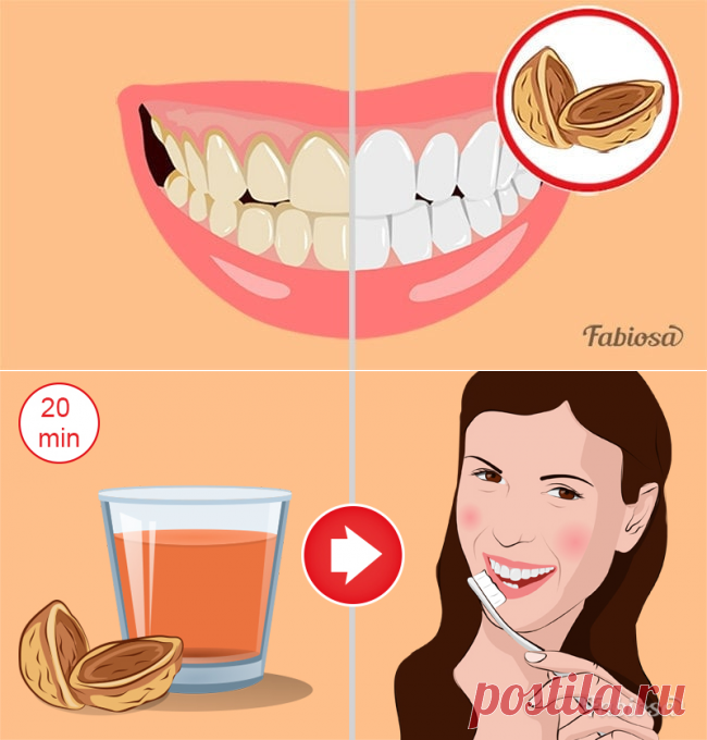 Доступное домашнее средство от зубного налета. Альтернатива чистке в клинике!