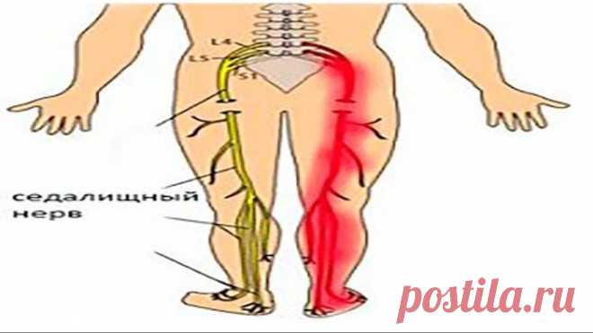 Воспаление седалищного нерва. Лечение в домашних условиях.