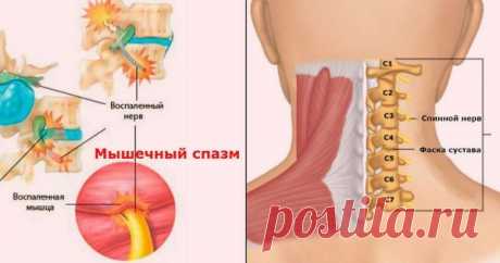 Мышечные зажимы шеи и спины: избавилась раз и навсегда! — Копилочка полезных советов