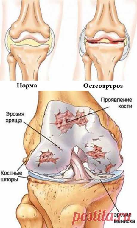 Характеристика остеоартроза коленного сустава: причины, симптомы, лечение | Познавательный сайт ,,1000 мелочей&quot;