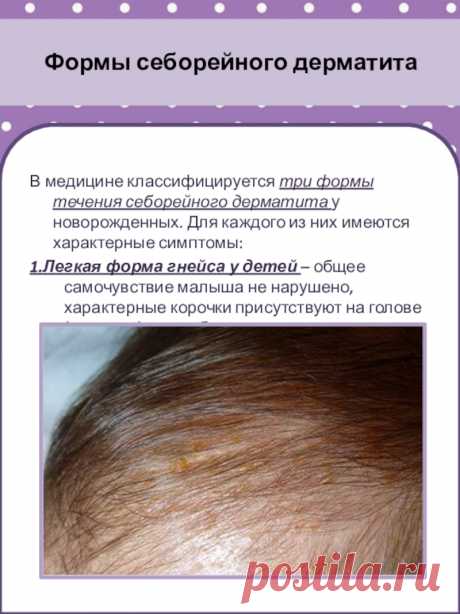Себорея на лице: причины, симптомы и методики лечения