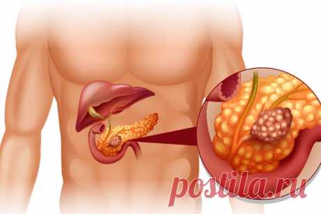 Современная онкология. Как лечат рак поджелудочной железы. Среди различных видов опухолей органов желудочно-кишечного тракта рак поджелудочной железы считается наиболее агрессивным. И большая часть всех случаев злокачественных новообразований обнаруживается на поздних стадиях.