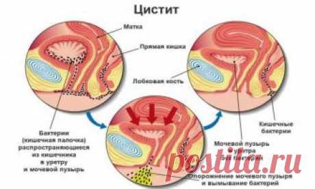 Воспаление мочевого пузыря: лечение, симптомы, причины, лекарства, таблетки | Азбука здоровья