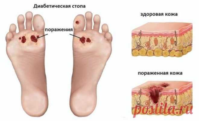 Диабетическая стопа: что это и как лечить? | Всегда в форме!