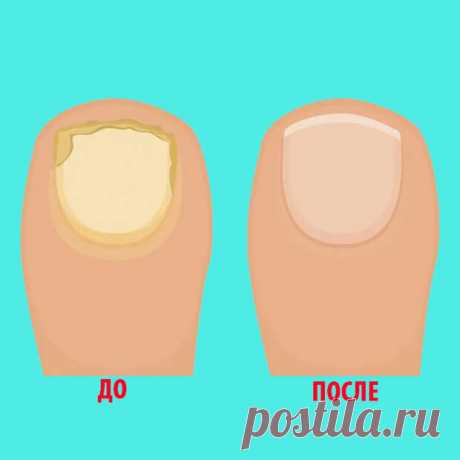Что полезно знать про грибок ногтей
Грибок ногтей (или онихомикоз) – это инфекция, которая поражает ногтевую пластину. Обычно причиной заражения выступают грибки-дерматофиты. Грибок меняет конфигурацию и цвет ногтя, в очаговой зоне возникает зуд, покраснение. Беспокоит резкий запах ног. Как избавиться от онихомикоза?          Грибок ногтей (онихомикоз) относится к инфекционным недугам. Его...
Читай дальше на сайте. Жми подробнее ➡