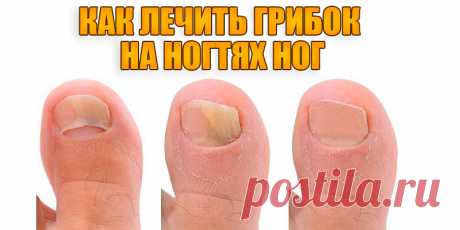 Как лечить грибок на ногтях ног | Полезные советы
