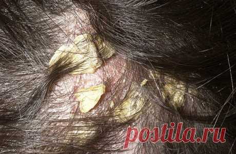 Атопический дерматит волосистой части головы: демодекоз, дерматофития, дерматомикоз, пиодермия, стрептодермия, видео-инструкция по лечению своими руками, симптомы, фото и цена