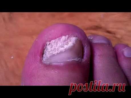 ВЫЛЕЧИЛ грибок Лечение грибка ногтей