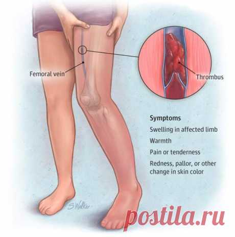 Признаки тромбоза, которые опасно игнорировать - Народная медицина
                                             - 9 февраля
                                             - 43056503892 - Медиаплатформа МирТесен Тромбоз – опасная ситуация, которую нельзя оставлять без внимания. Наличие тромба в организме может привести даже к летальному исходу, поэтому важно знать первые признаки тромбоза. А при их обнаружении необходимо срочно обратиться к врачу. Тромб – это кровяной сгусток...