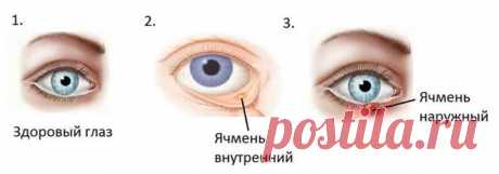 12 рецептов лечения ячменя на глазу. Если часто страдаете от этой напасти — применяйте, и проблем не знайте | Люблю Себя