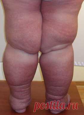 Лимфостаз нижних конечностей: лечение и фото симптомов болезни